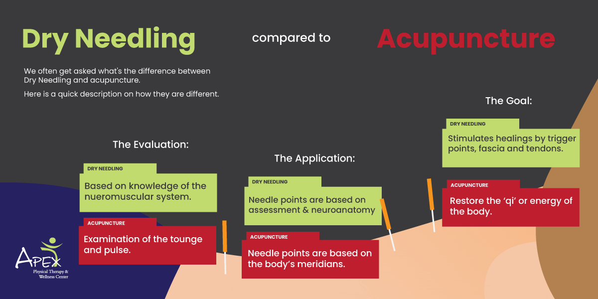 Dry Needling VS Acupuncture: find out the differences.